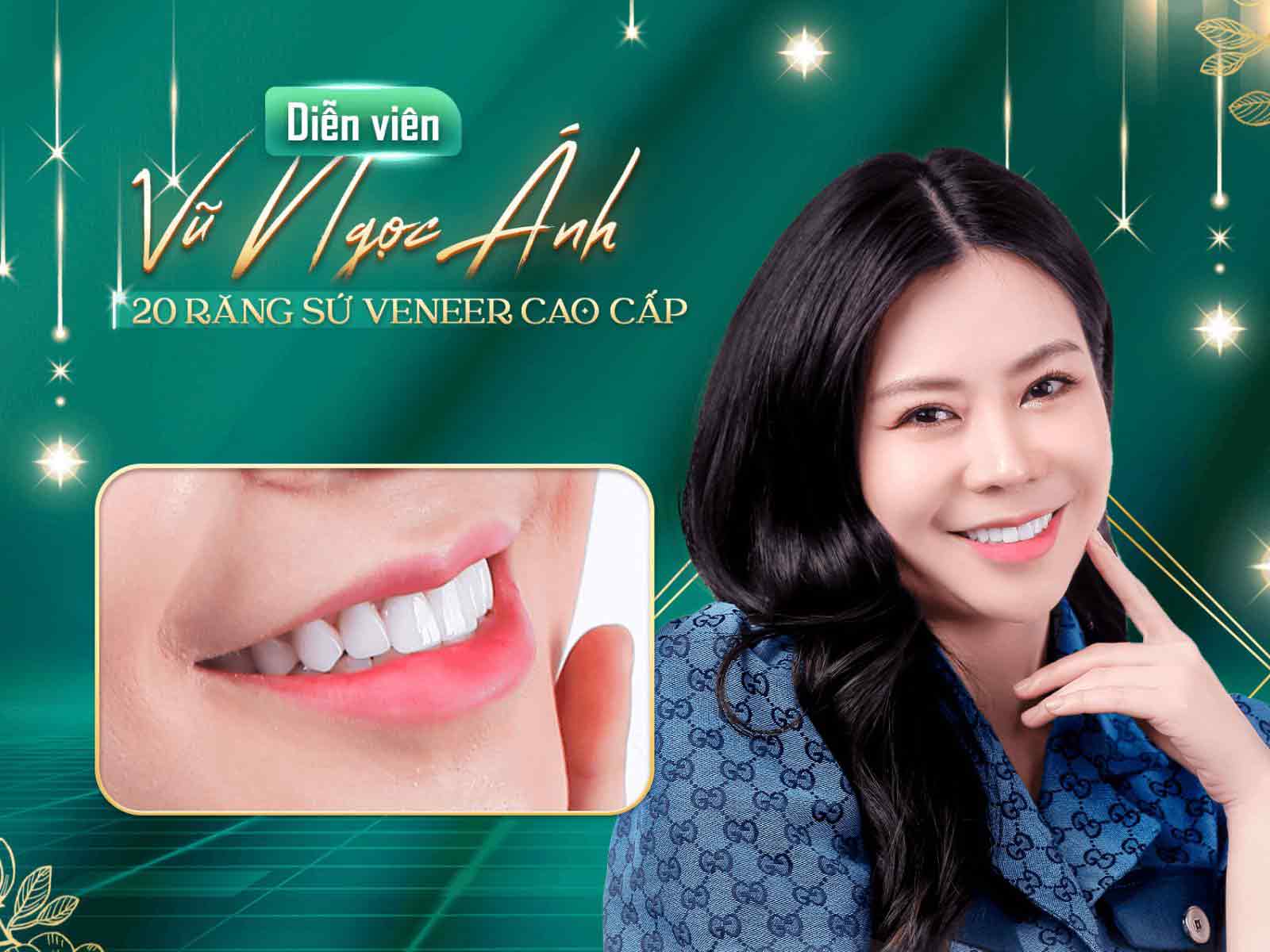 diễn viên Vũ Ngọc Ánh làm răng sứ tại nha khoa casino online uy tín



